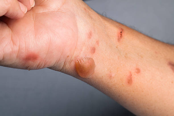 How To Treat A Burn From A Hot Pan 2