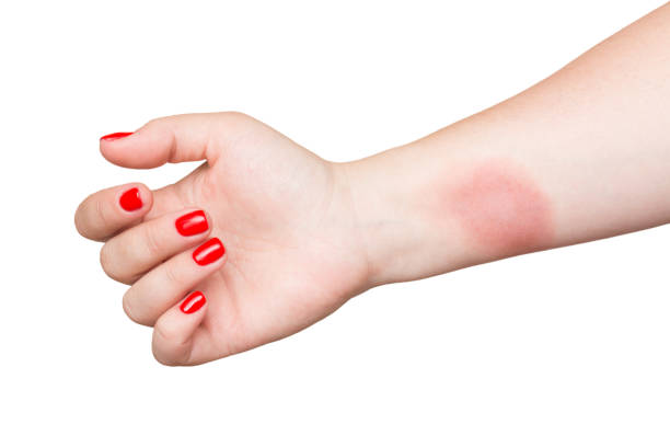 How To Treat A Burn From A Hot Pan 24